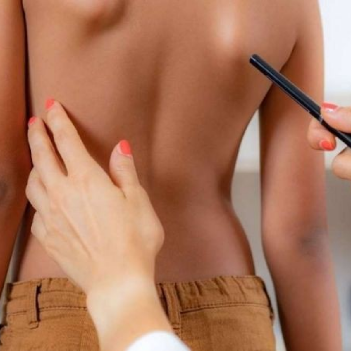 Vẹo cột sống chữ S hiếm gặp hơn nhưng lại phức tạp hơn