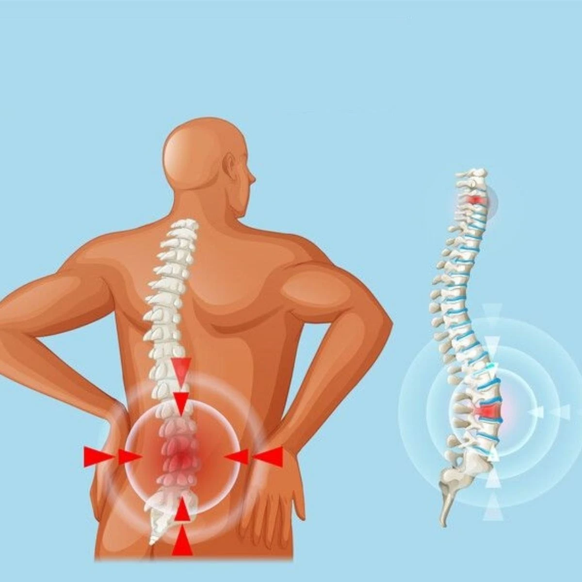 Phương pháp điều trị bằng thuốc cải thiện triệu chứng thoát vị khu vực đĩa đệm