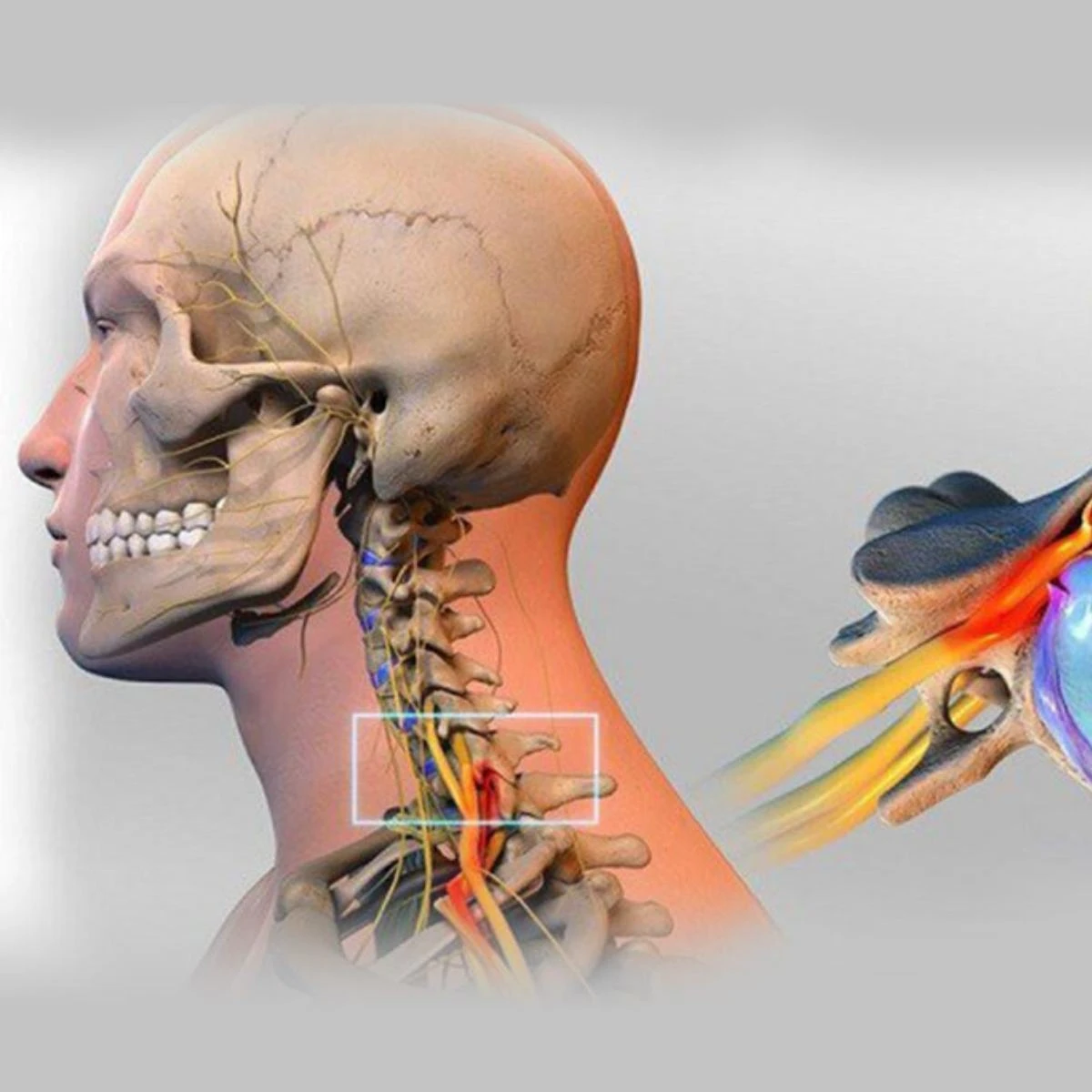Thoát vị cột sống cổ gây ra nhiều triệu chứng khó chịu