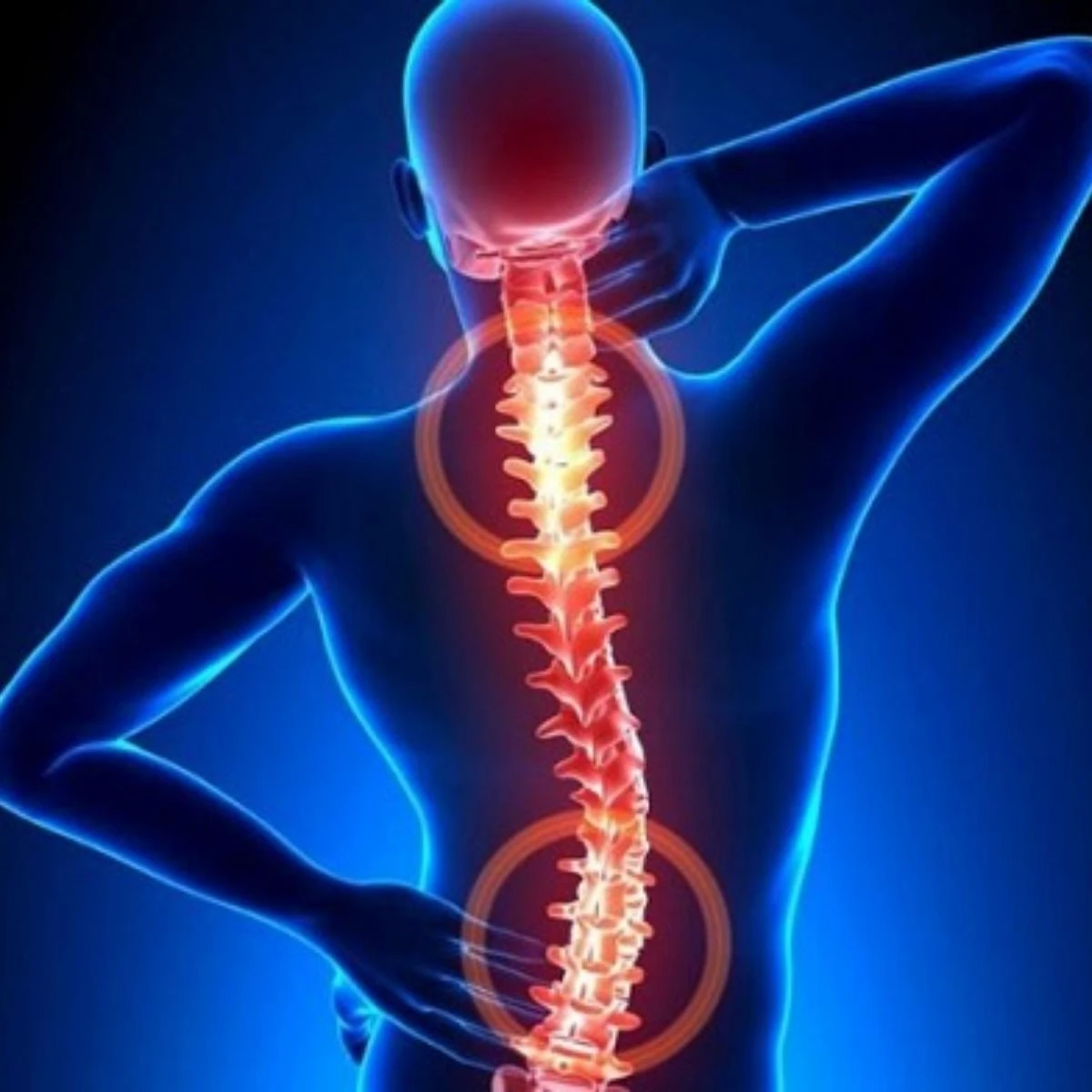 Bệnh lý thoát vị đĩa đệm do bao xơ bao quanh bị rách hoặc nứt